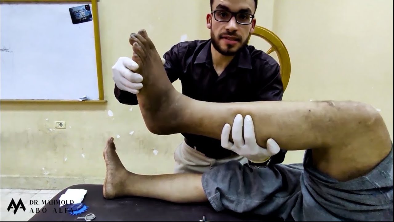 Reflex Assessment (Superficial – Deep - Pathological)(Clonus)–Motor  Examination-Neurological Sheet