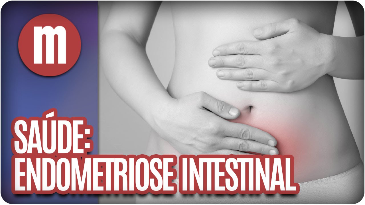 Endometriose intestinal - Saúde - Mulheres (21/07/16)