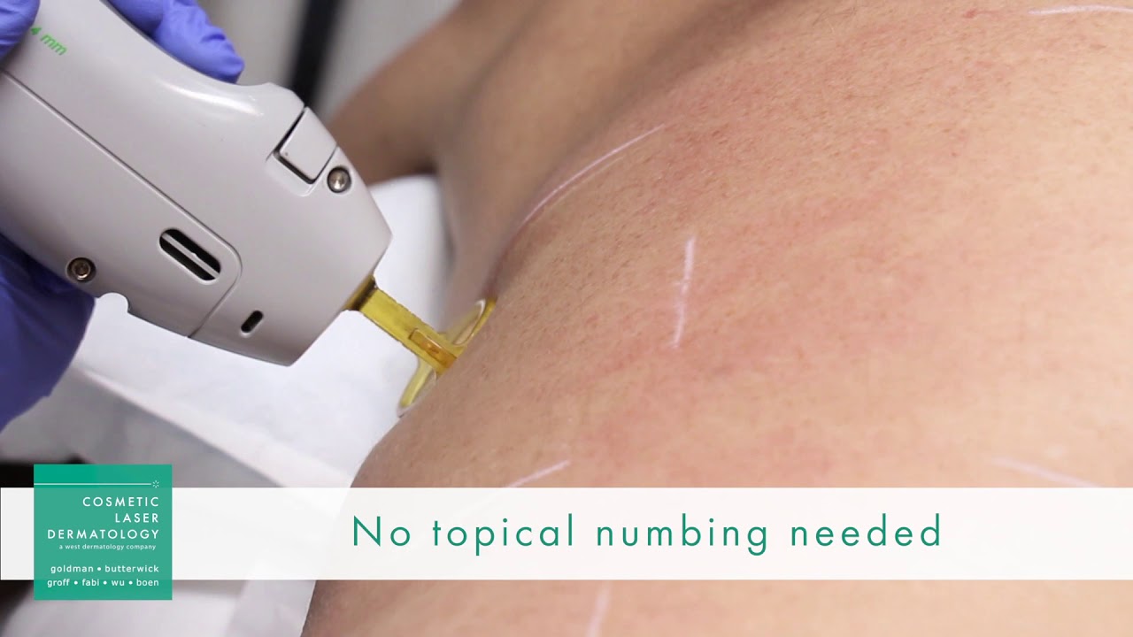 Laser Hair Removal Procedure Demonstration by Leysin Fletcher, PA-C
