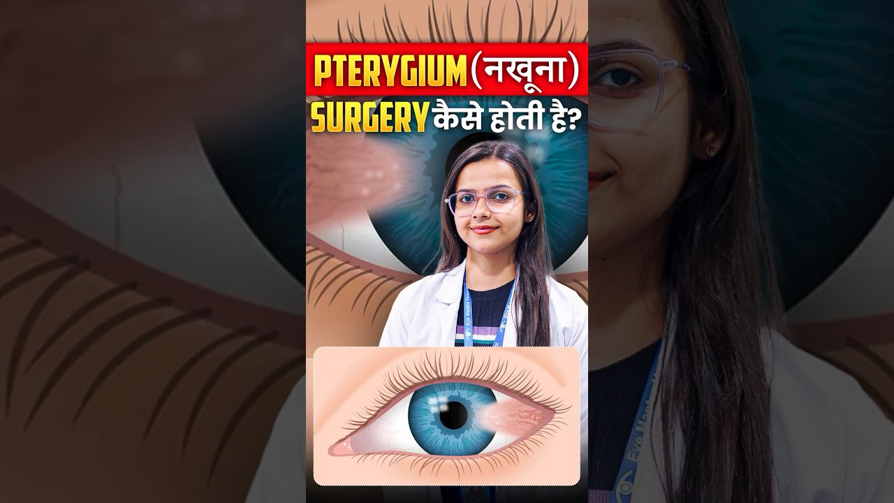 Pterygium (Surfer&rsquo;s Eye): Causes, Symptoms & Treatment