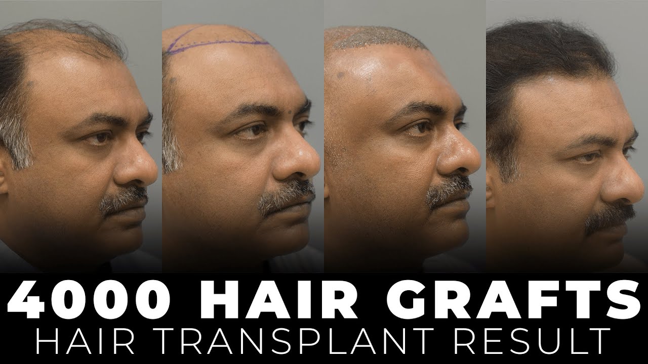 Shocking Transformation: Hair Transplant Before-After | Trichometric Sapphire FUE #caraclinic