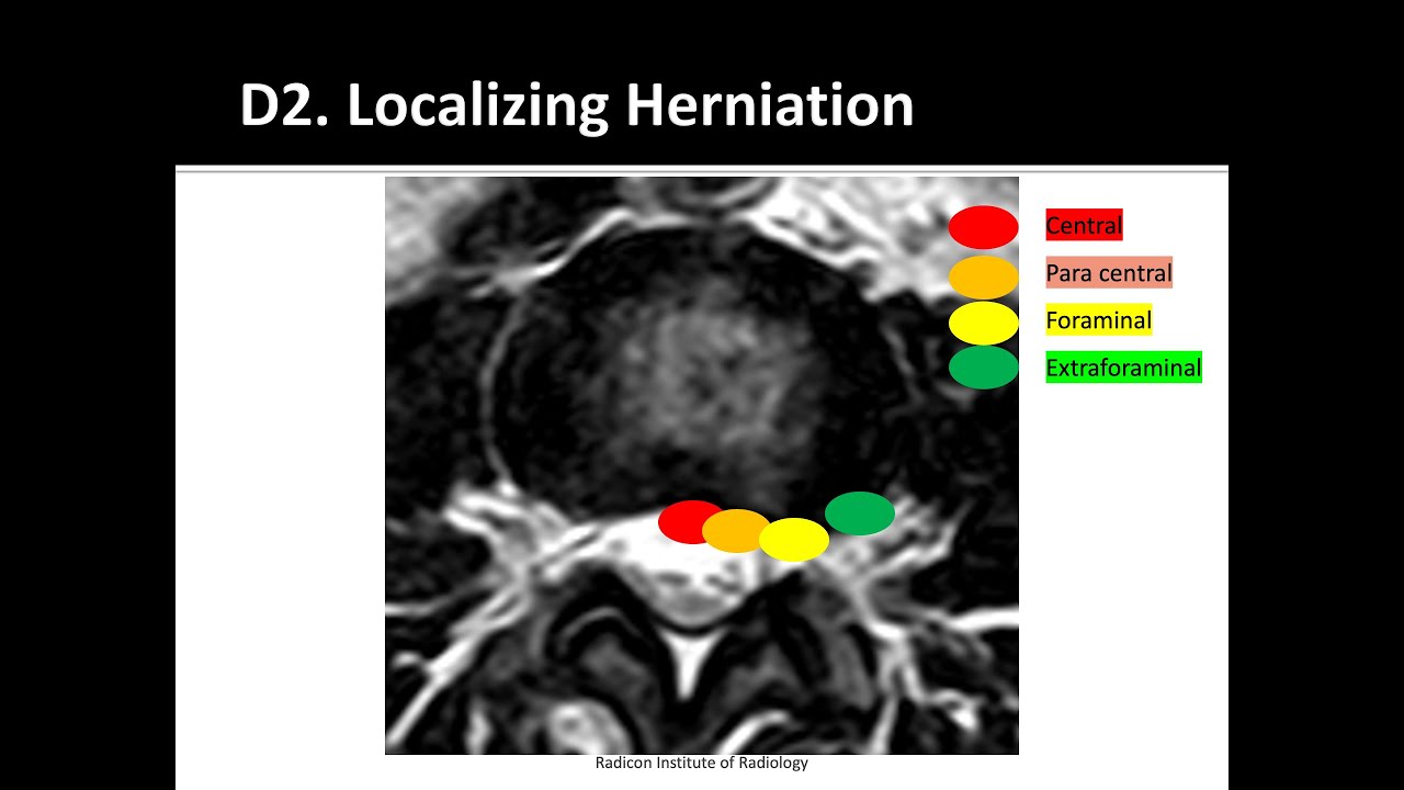 Lumbar Spine MRI Part 11: Disc prolapse nomenclature