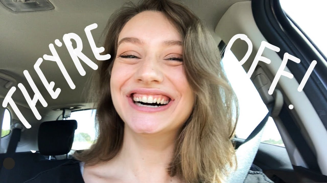 I GOT MY BRACES OFF!! // deep overbite, crowding, bite plate, rubber bands