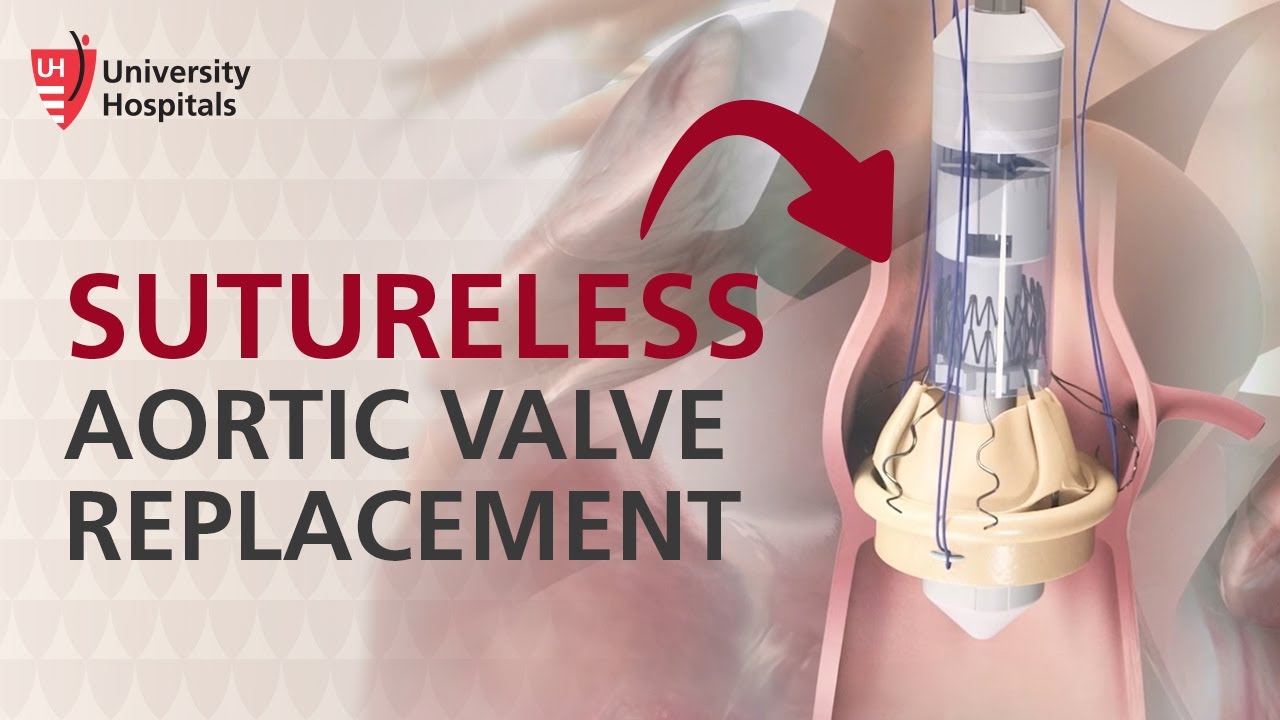 Heart Surgery: Perceval Sutureless Aortic Valve Replacement