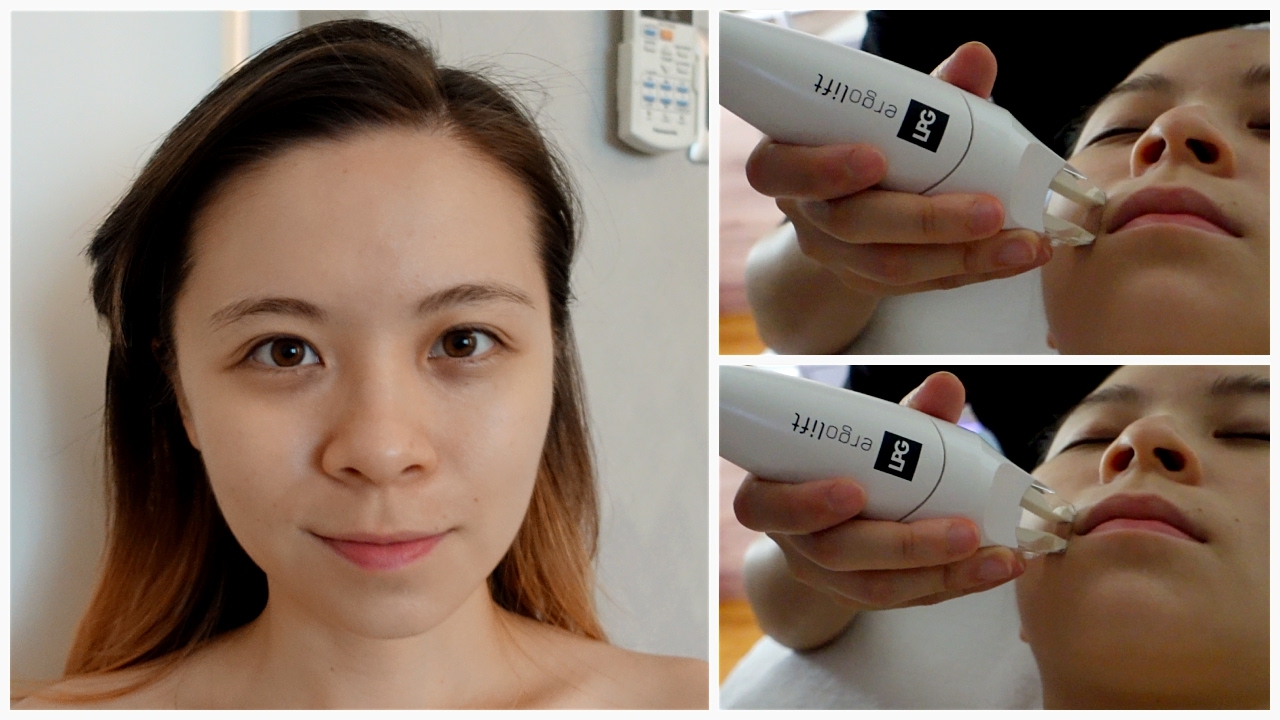 What LPG Non-Surgical Face Lift Facial Looks Like? \\ JQLeeJQ