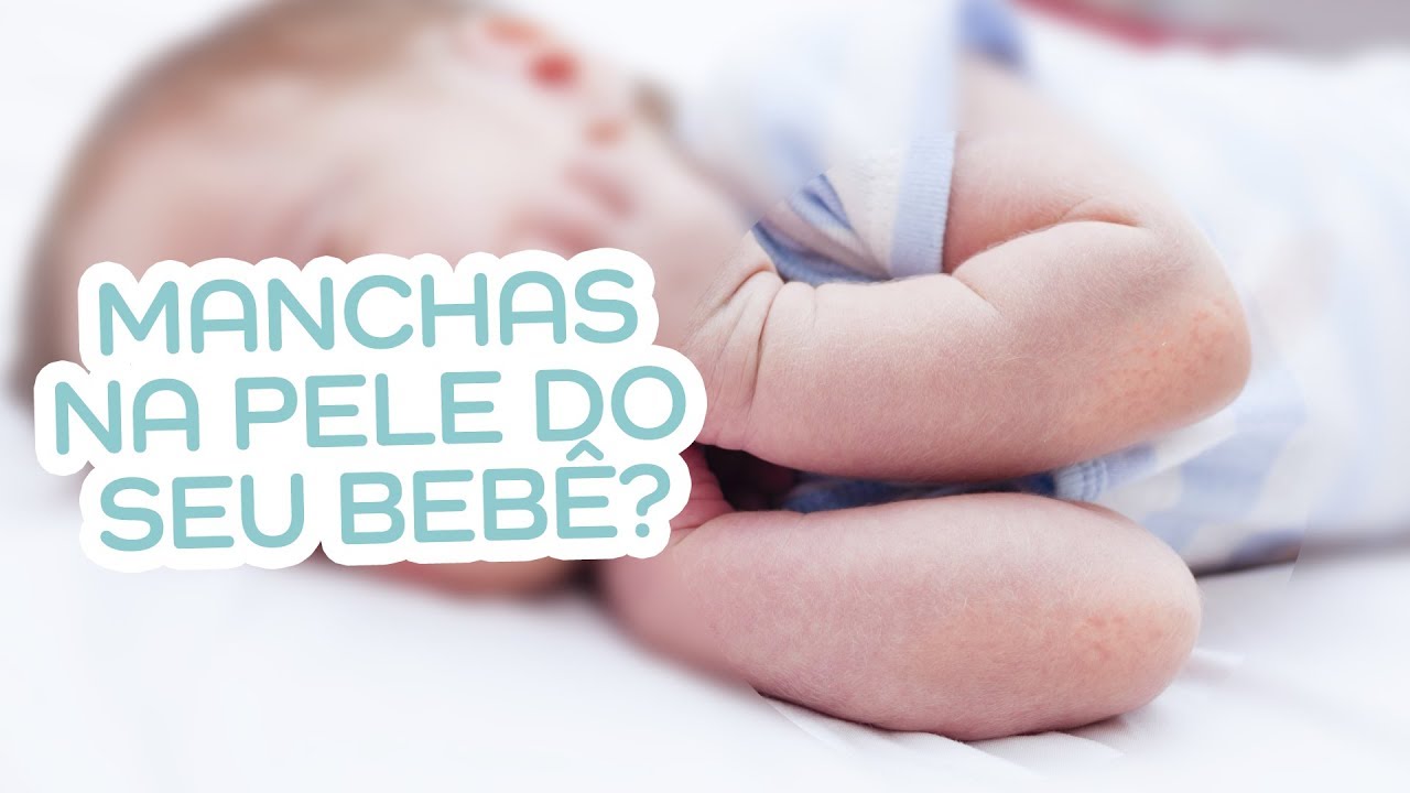 Seu filho está com mancha na pele? Pode ser Dermatite Atópica...