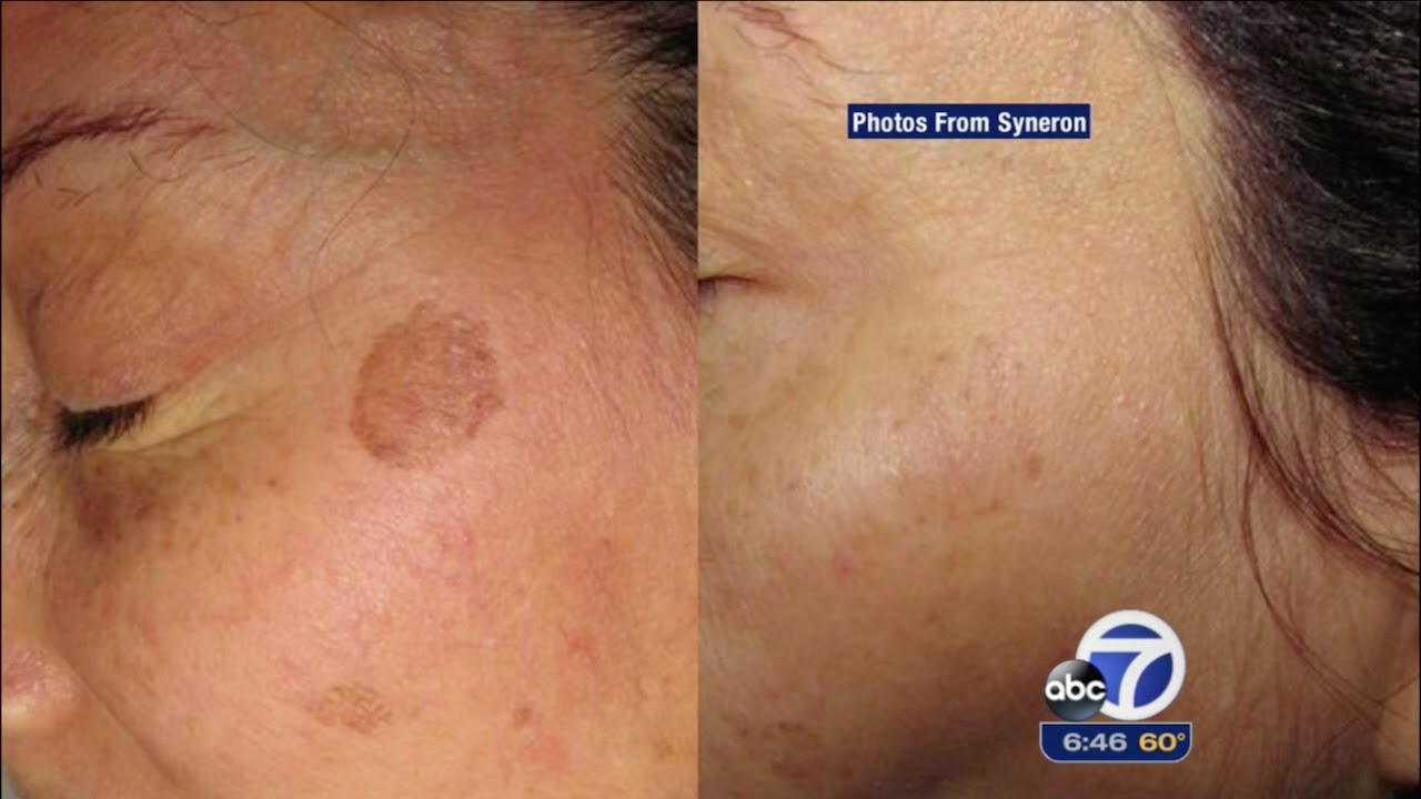 PicoWay Laser for Skin: Remove Tattoos and Brown Spots | The Plastic Surgery Clinic