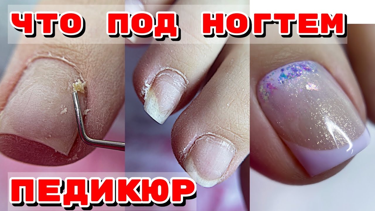 ОГРОМНЫЕ ПОДНОГТЕВЫЕ МОЗОЛИ 😧 Длиннющие ногти 💅 Педикюр френч