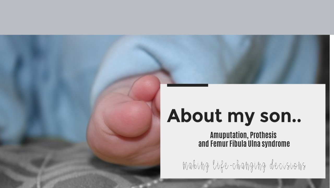 STORY TIME | ABOUT MY SON | FEMUR FIBULA ULNA SYNDROME | AMPUTATION