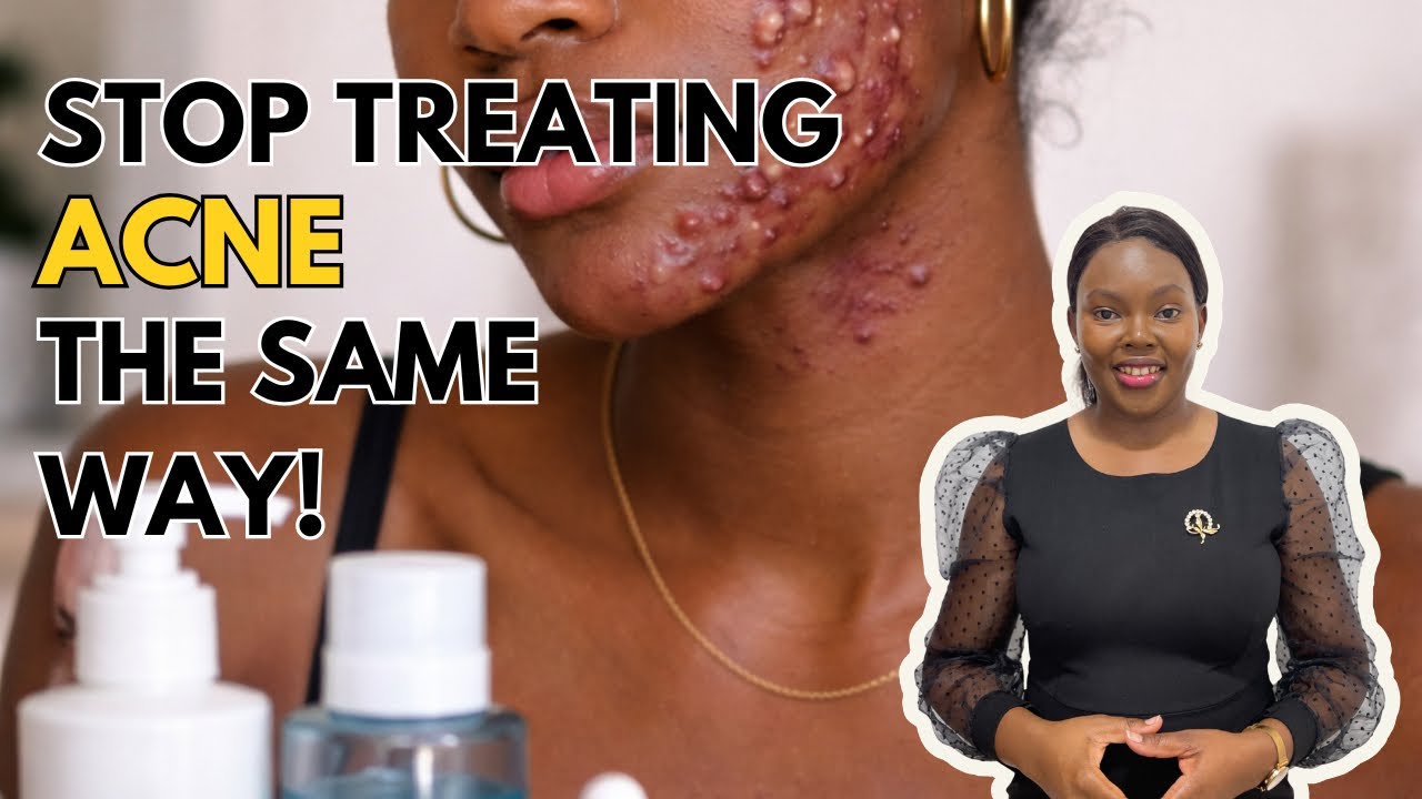 Stop Treating All Acne The Same Way | ACNE SERIES | EPISODE 2