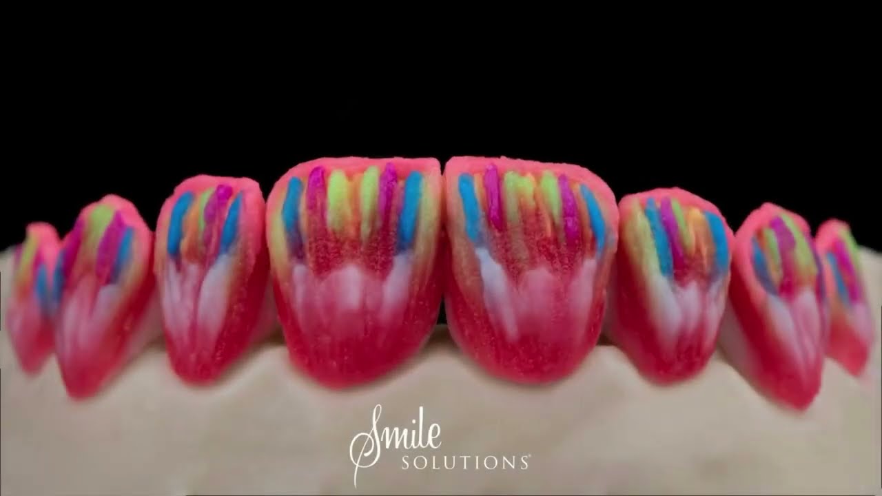 Porcelain Veneers multi-layering with Emax Press and Cream technique