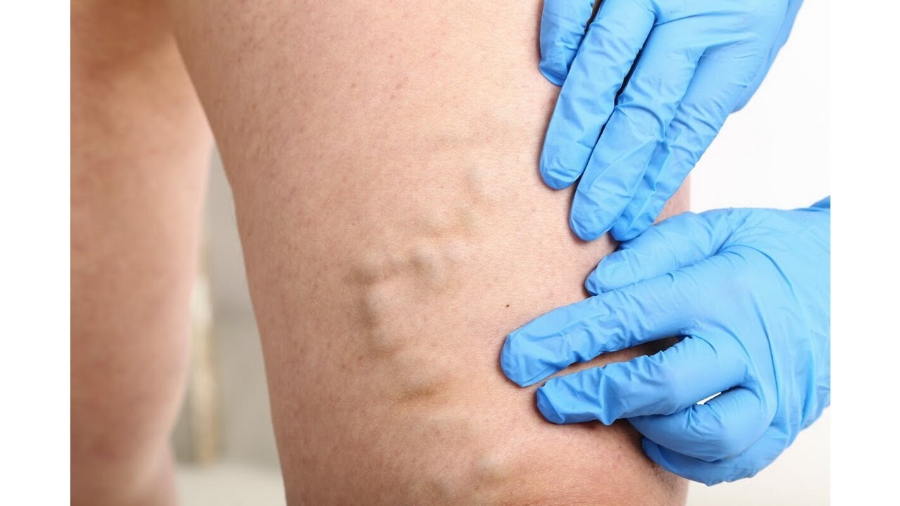 Varilux Premium - Gambe Sane e Belle - Elimina dolore e pesantezza alle gambe!