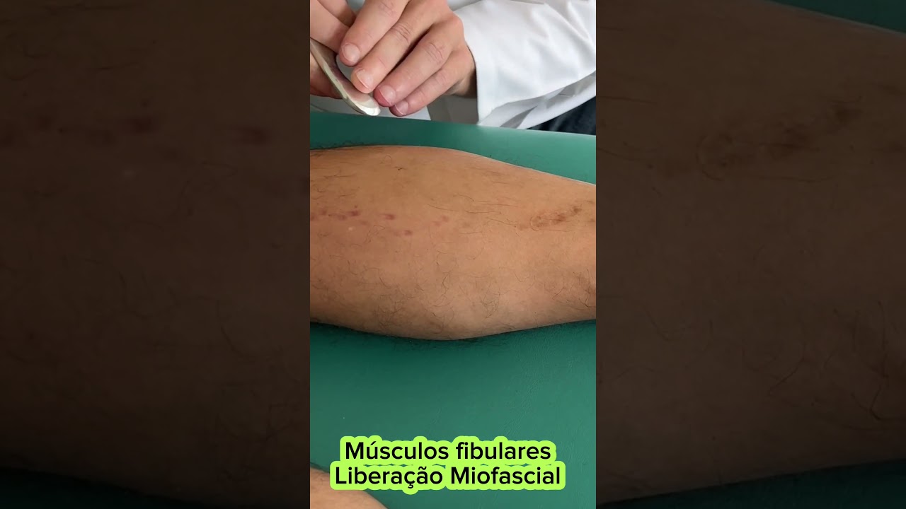 Liberação miofascial - Músculos fibulares