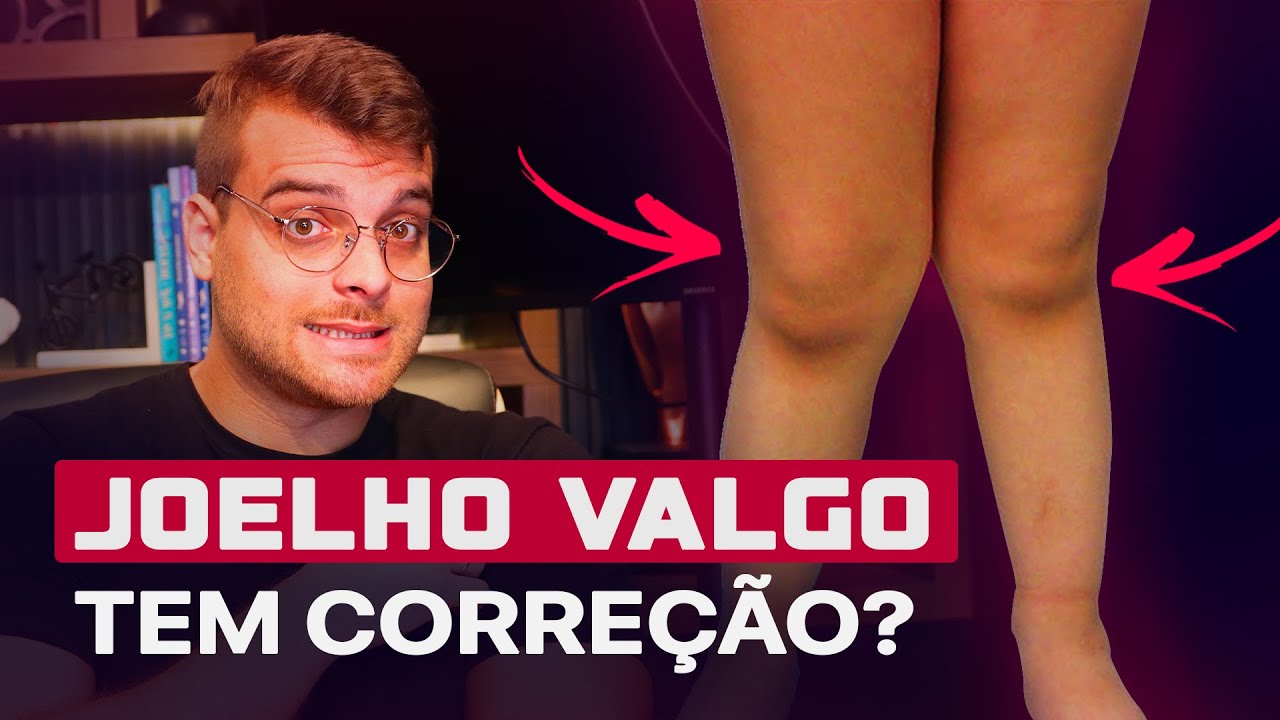 O que é JOELHO VALGO? Tem correção? Quais as causas? | João Franken