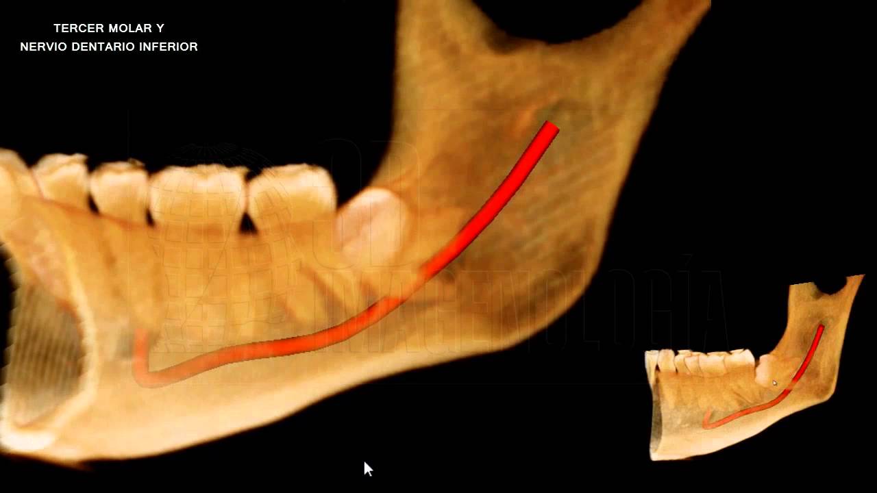 TERCER MOLAR Y CONDUCTO DENTARIO INFERIOR (Tomografía Cone Beam)