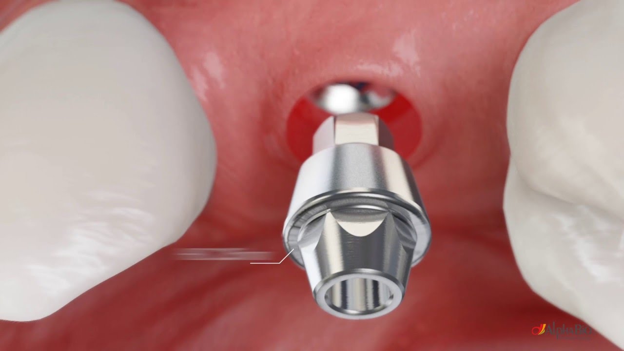 Protesi avvitata su dente singolo con sistema HBC