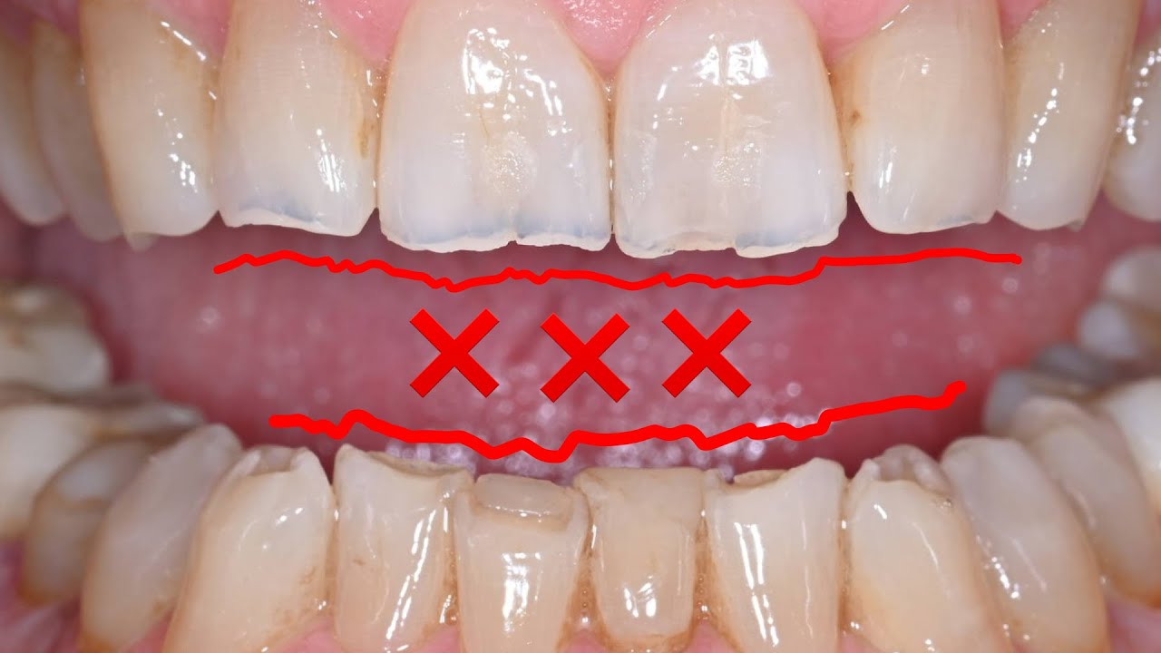 Un Nemico Silente che Minaccia i Tuoi Denti