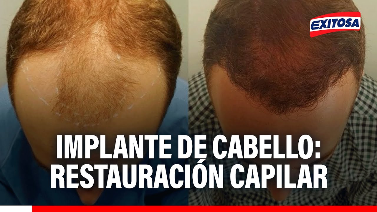 🔴🔵 Implante de cabello: Restauración capilar
