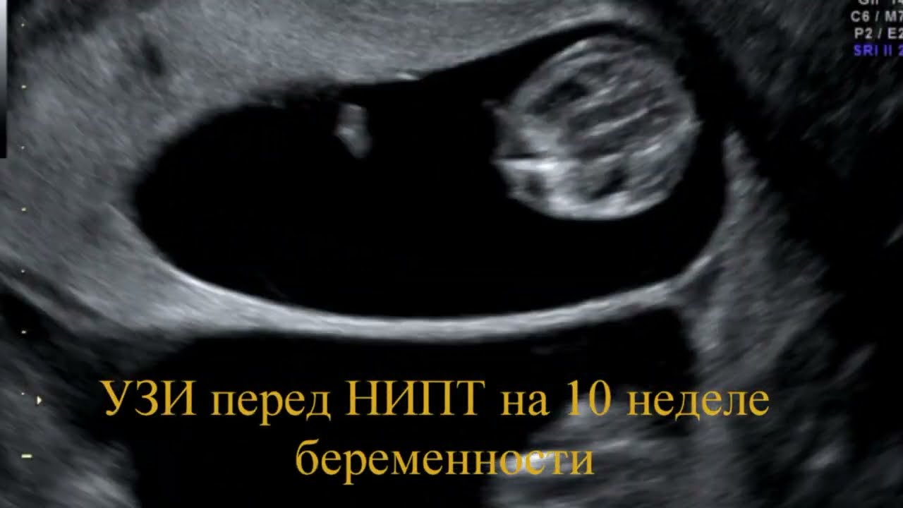 узи перед нипт на 10 неделе беременности