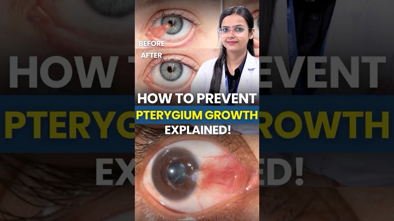 How to Prevent Pterygium from Growing | Eye Protection Tips 👀