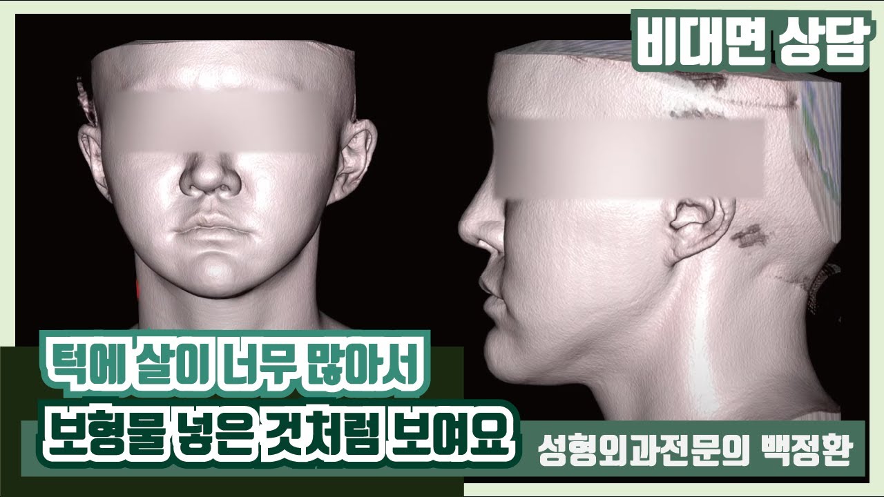 (SUB) 턱에 살이 너무 많아서 보형물을 넣은 것처럼 보여요 [비대면상담 #63] / I have so much fat on my chin...