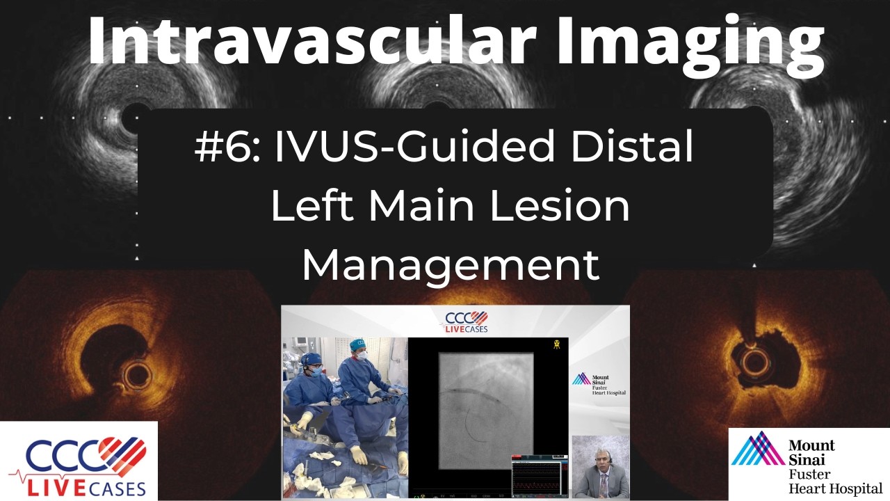 IVUS-Guided Distal Left Main Lesion Management