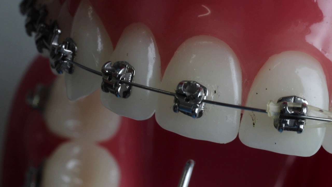How to Manage a Broken Bracket (Orthodontic emergency)