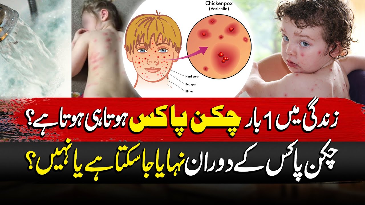 Chicken Pox In Children | Effective chicken pox treatment🦠🤒 | Good Morning Lahore | 03 Feb 2026