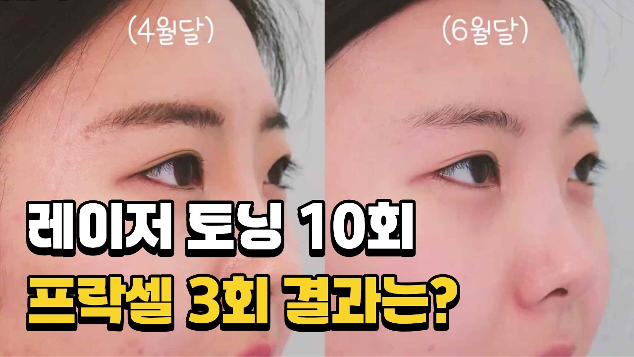 돈 버린 줄 알았는데 사진 보고 소름 돋았습니다.. 피부과 의사도 놀란 토닝 전후 차이