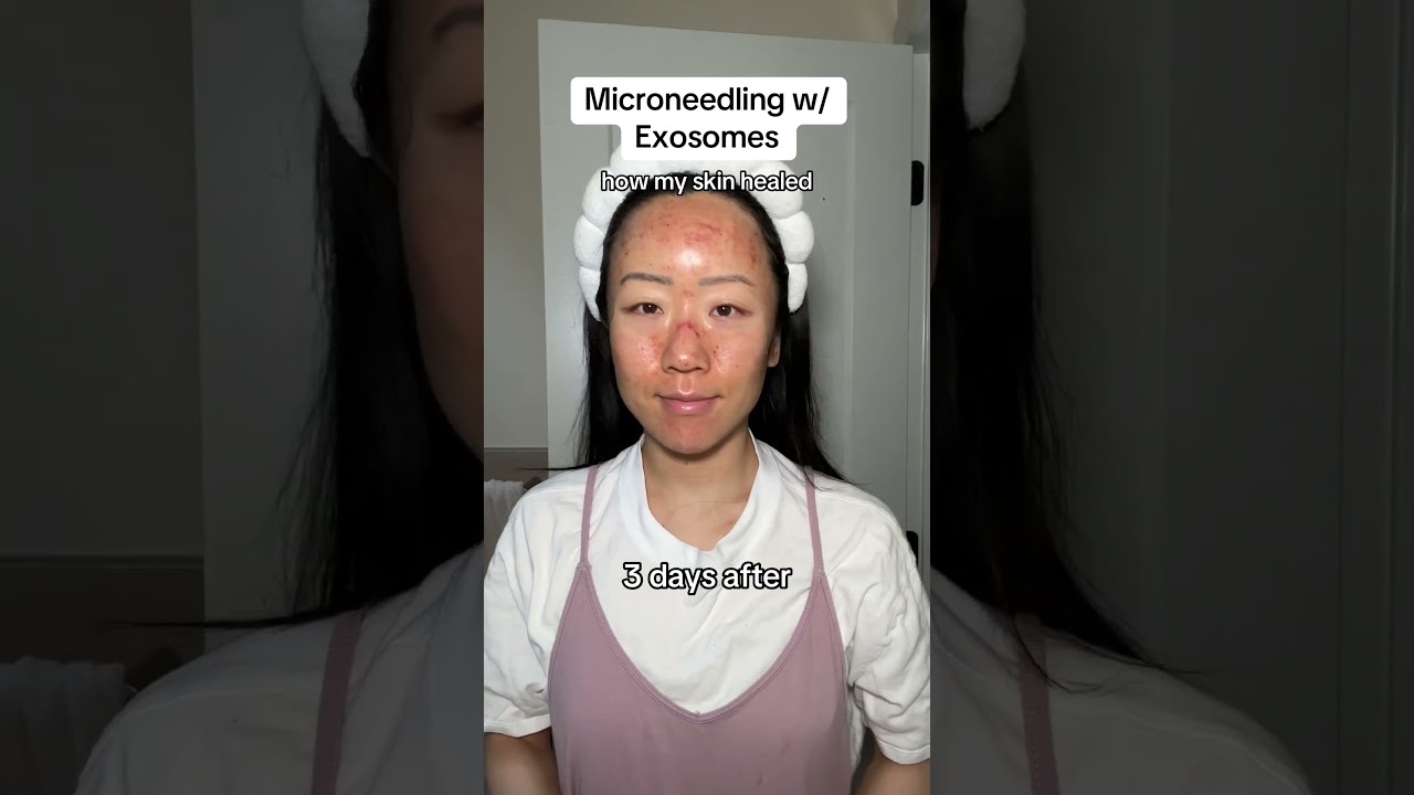 My results from Microneedling with Exosomes! First 7 days post treatment #shorts