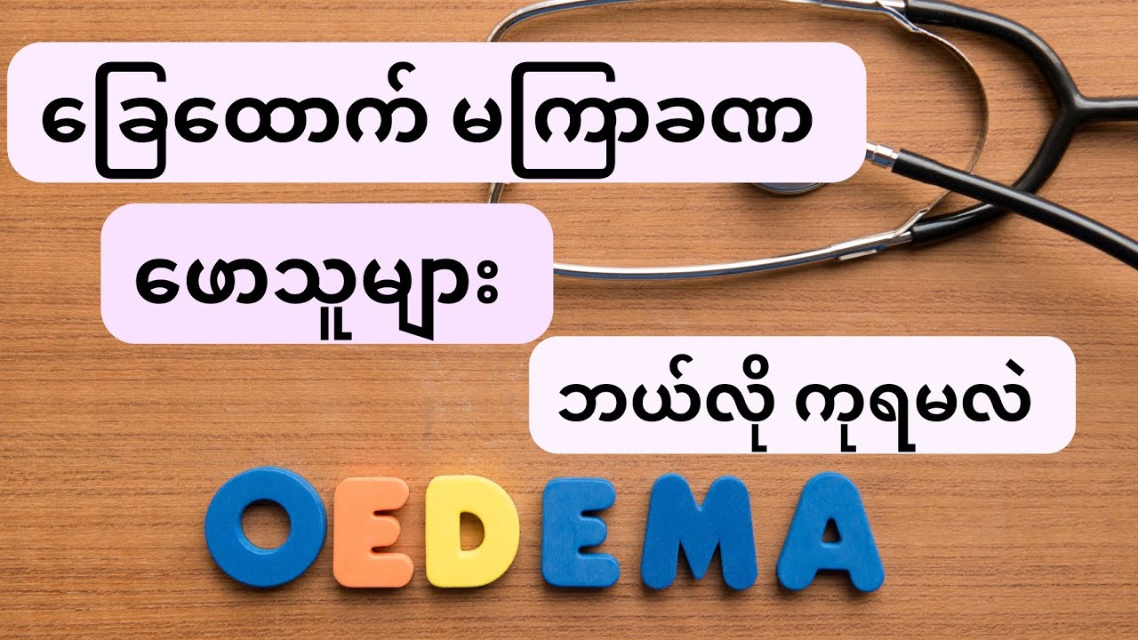 ခြေထောက် မကြာခဏ ဖောသူများ ဒီဗီဒီယိုကို ကြည့်ပါ - oedema and treatment
