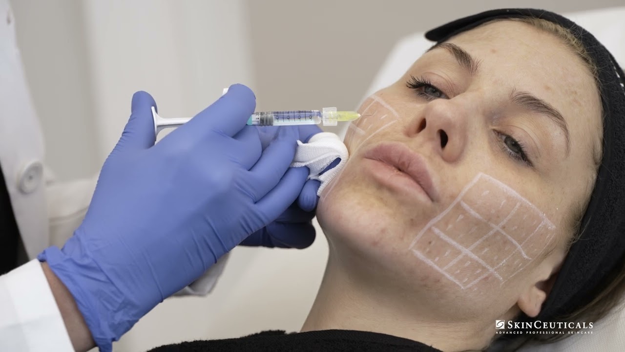 Skin Booster Behandlung mit Dr. Brandenburg