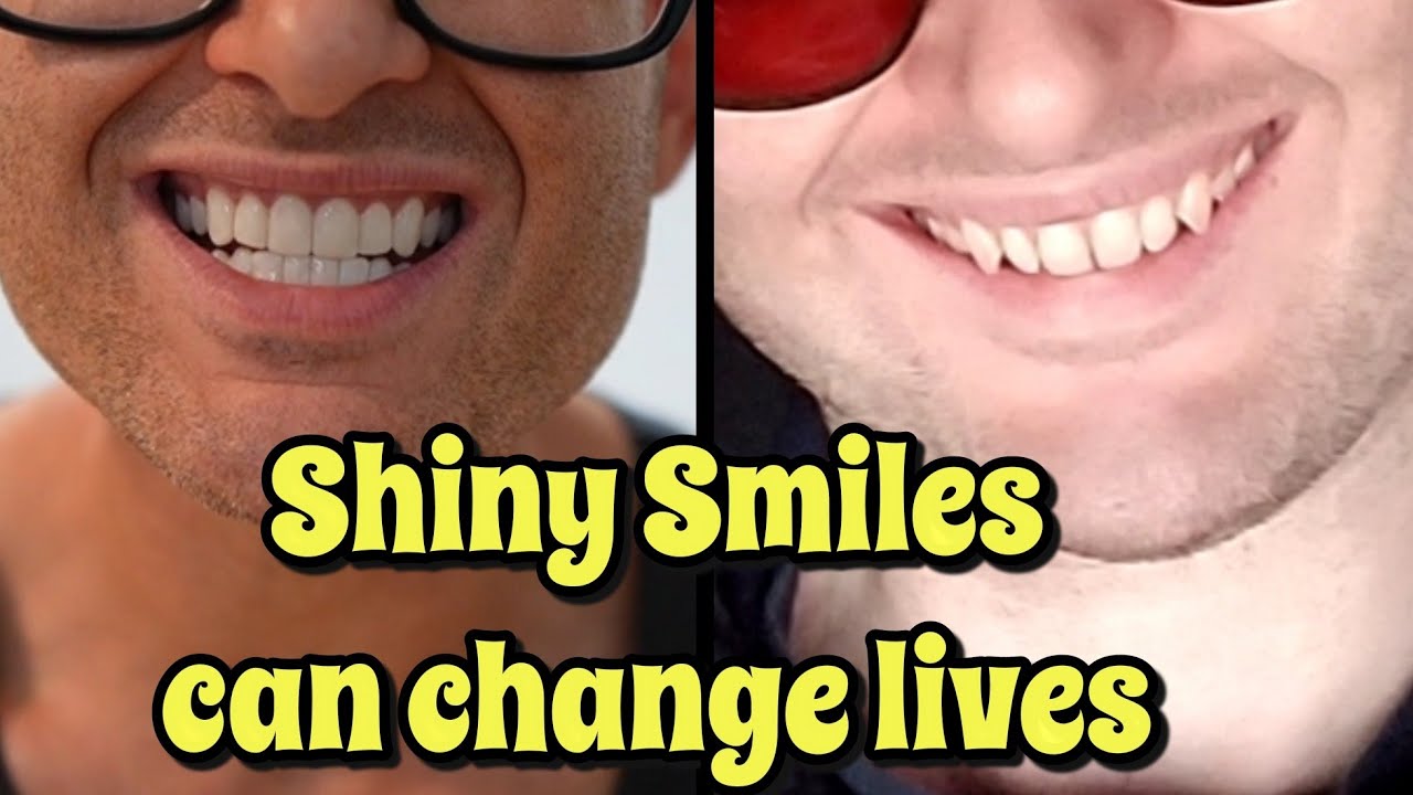 Shiny Smile Veneers | Honest 6 Month Review | Everything you need to know!
