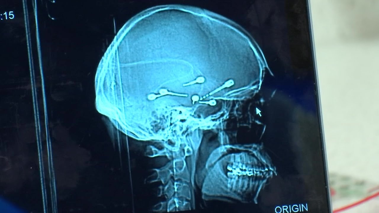 Brain surgery to treat epilepsy is changing lives