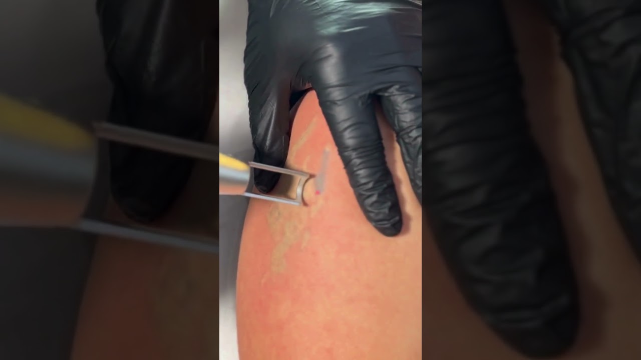 Tattoo Regret No More: Safe, Quick, and Painless Removal in San Antonio | Laser Tattoo Removal