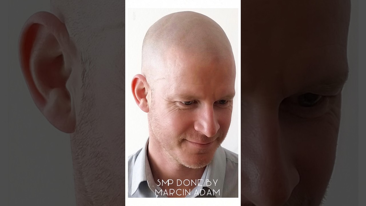 SMP treatment by Marcin Adam #smp #scalpmicropigmentation #hairtattoo #hairlinetattoo #scalp