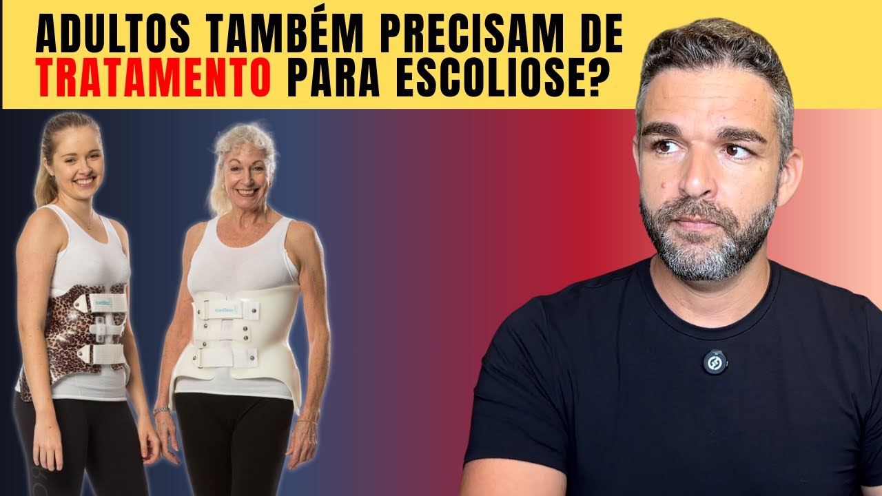 Escoliose no Adulto Pode PIORAR sem TRATAMENTO!