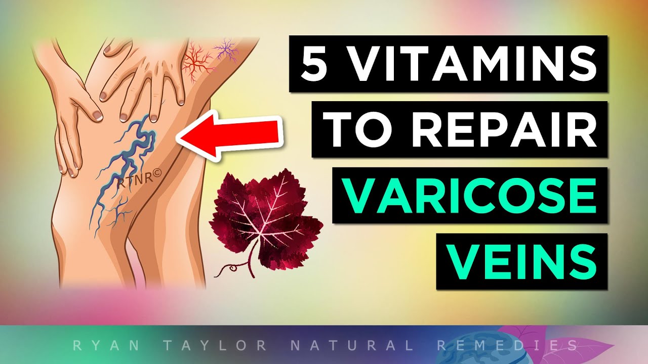 5 Vitamins For Venous Insufficiency (VARICOSE Veins Remedies)