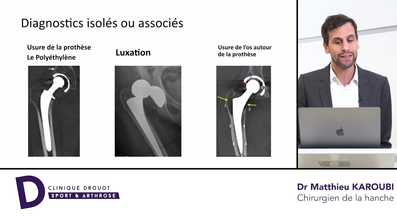 Je dois changer ma prothèse de hanche, pourquoi et comment faire ?