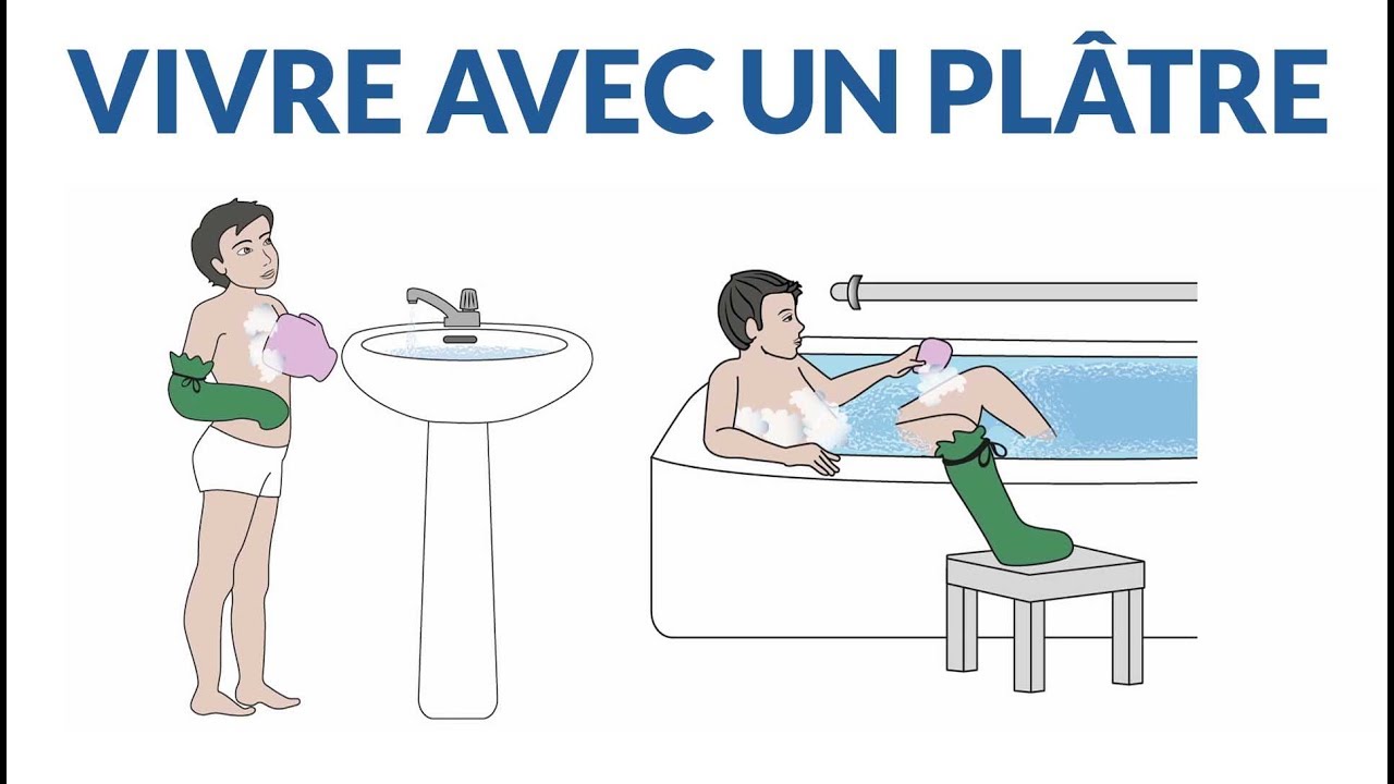 Comment vivre avec un pl&acirc;tre ?