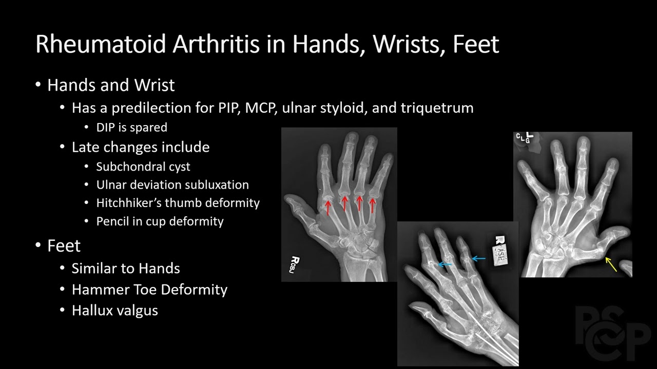 Rheumatoid vs Osteoarthritis - Radiology Medical Education