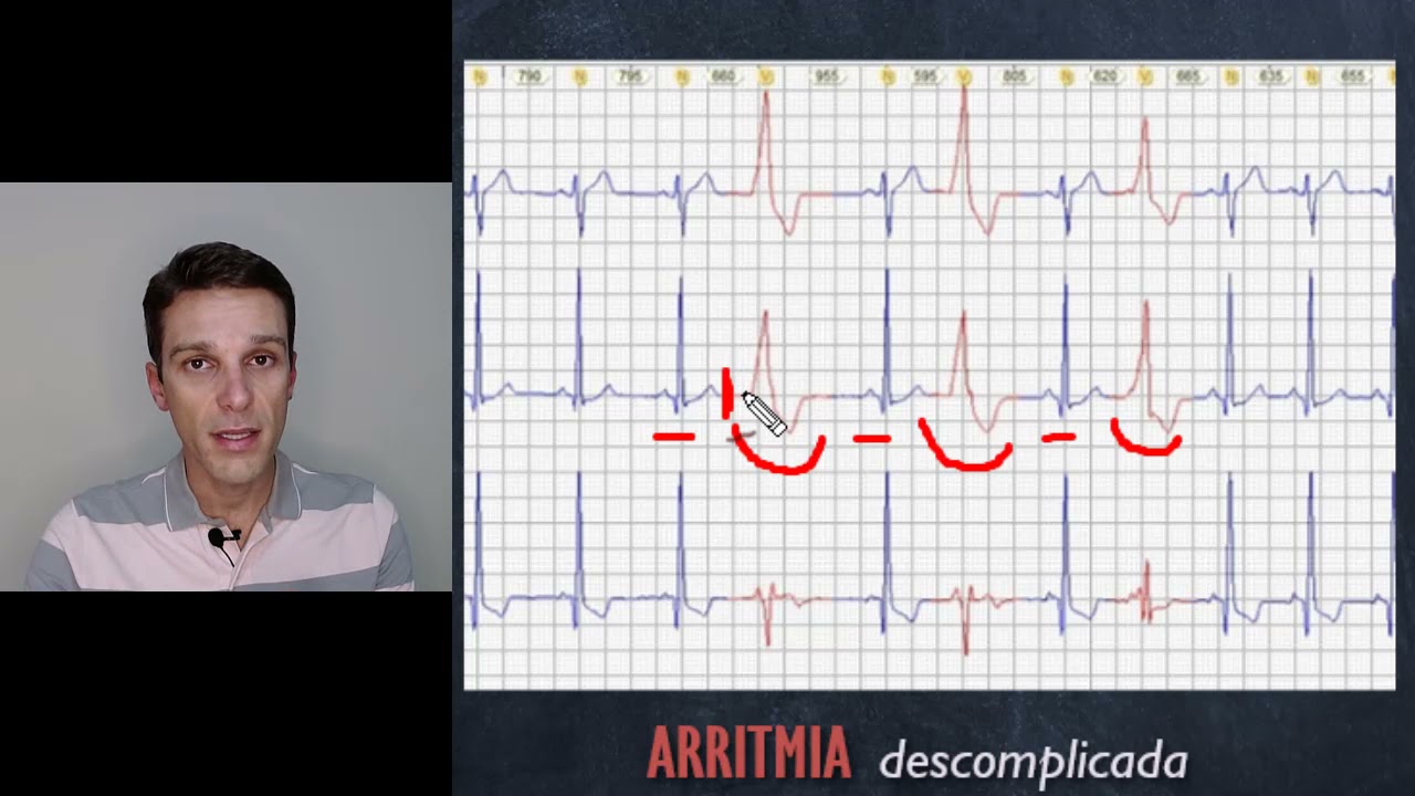 Bigeminismo ventricular