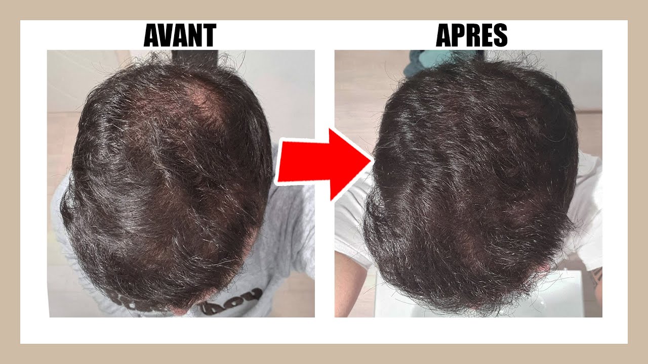 J'ai testé le sérum anti-chute et le complément croissance cheveux d'HORACE !