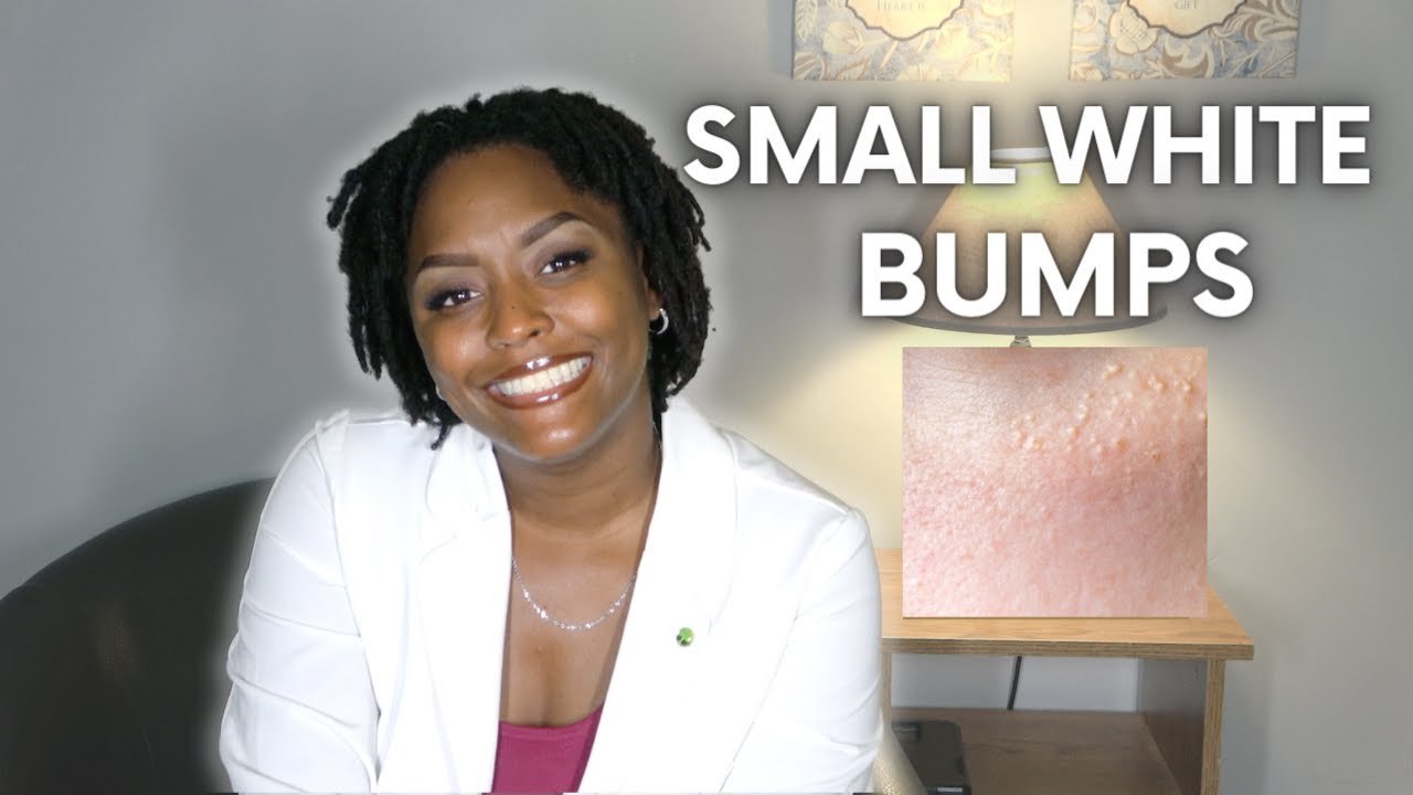 How to get rid of Milia? What causes it? What is the treatment?