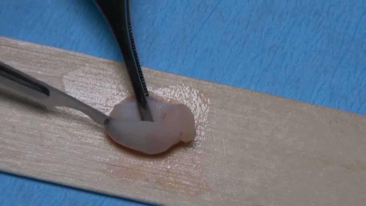 Injerto de Tuberosidad