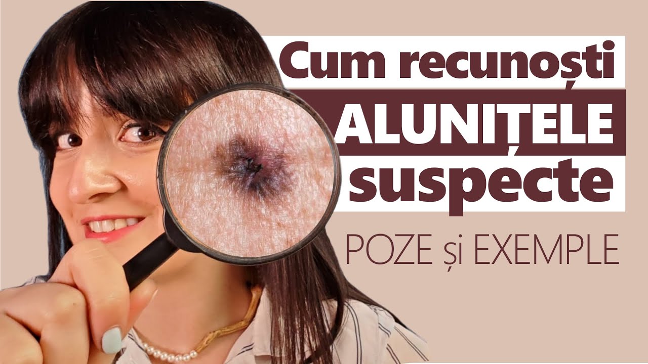 Cum să recunoști ALUNITE SUSPECTE + Melanom, Cancer de Piele
