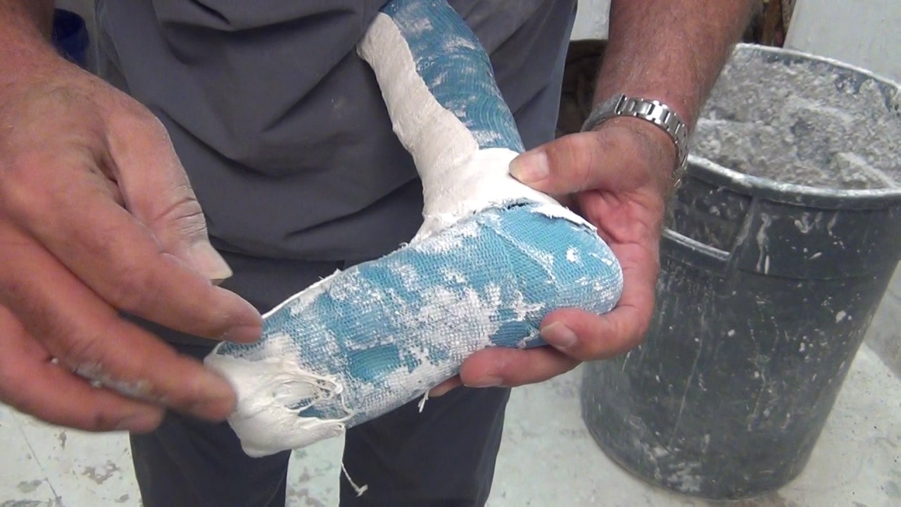 AFO Design: Wedging a negative cast to correct valgus/varus, DF/PF