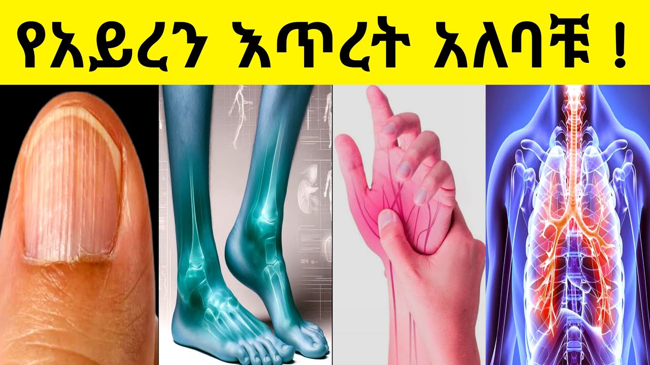የአይረን እጥረት 6 አደገኛ ምልክቶች | ማከም የምንችልባቸው ምግቦች | 6 signs of iron deficiency