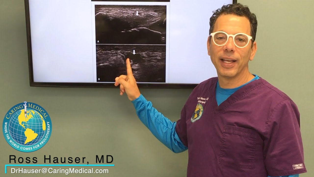 Helping medial arch and ankle pain with Prolotherapy after tendon graft surgery