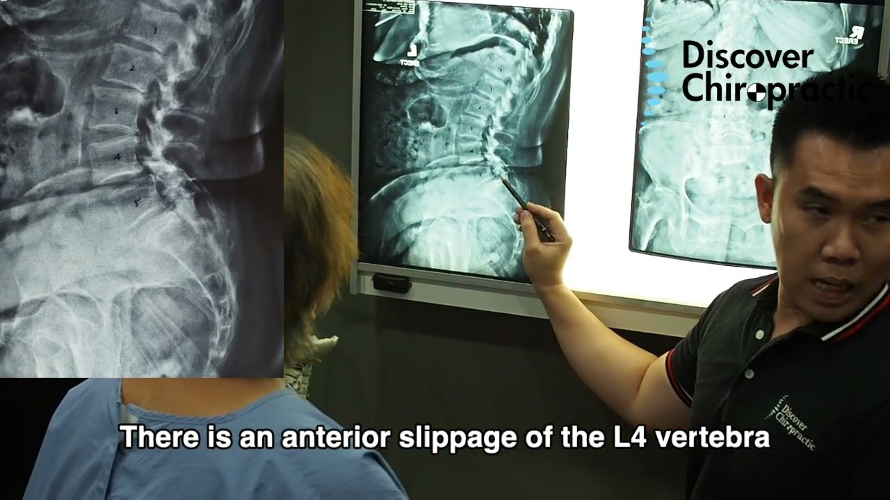 Spondylolisthesis in Walker GET HELPED from DC Sean Lee Gonstead Chiropractor 脊椎滑脱 坐骨神经痛 腰痛徒手治疗